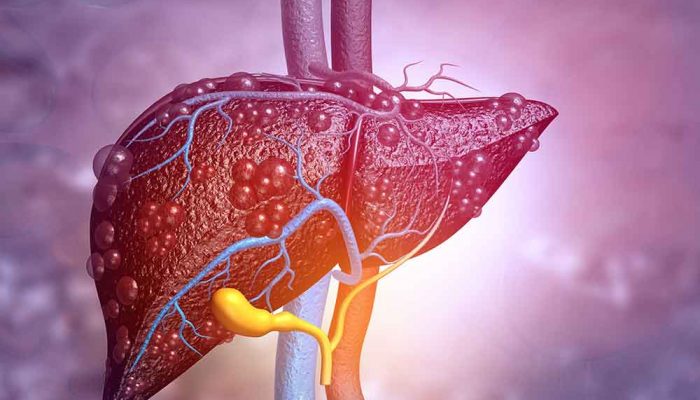 is-cirrhosis-reversible-fatty-liver-disease