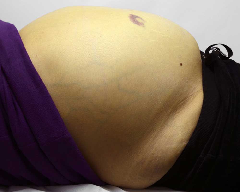 person's belly with enlarged liver