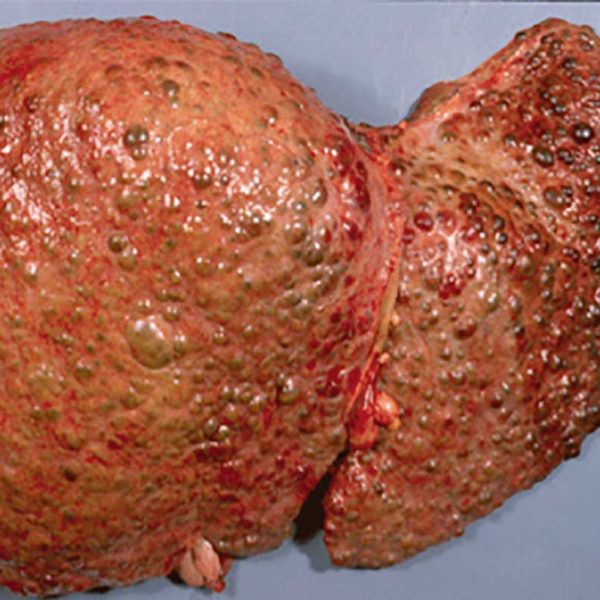 liver with signs of cirrhosis