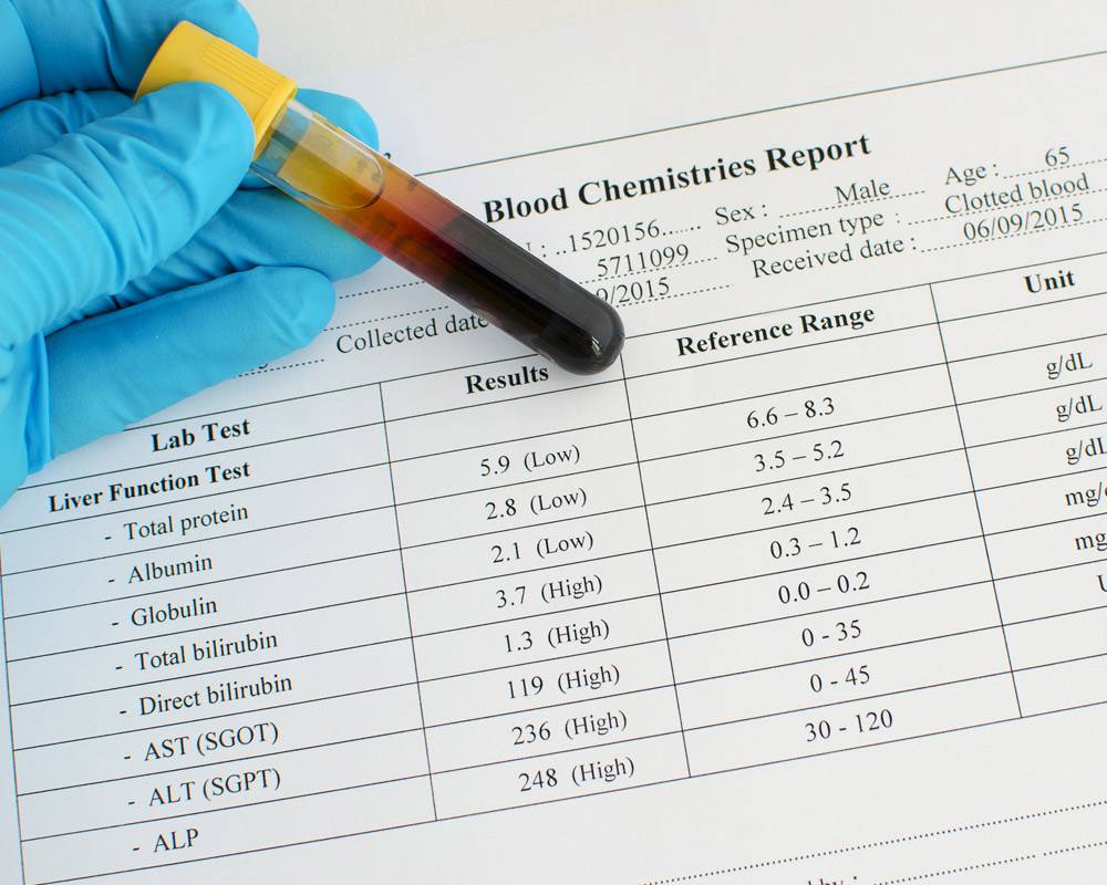 Jaundice Bilirubin Levels For Adults Fatty Liver Disease