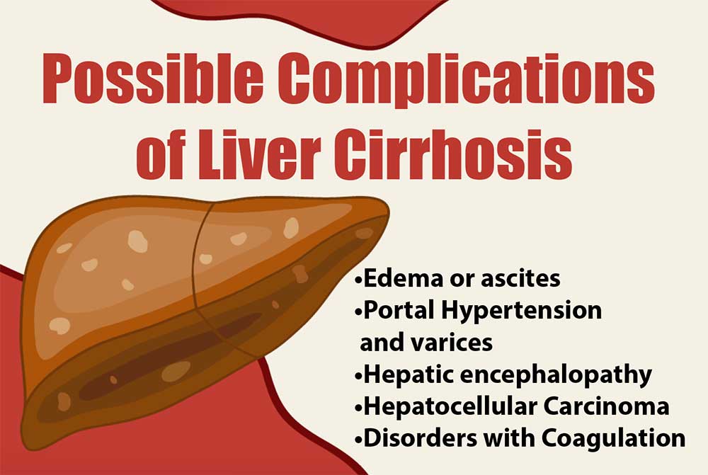 Possible Complications of Liver Cirrhosis