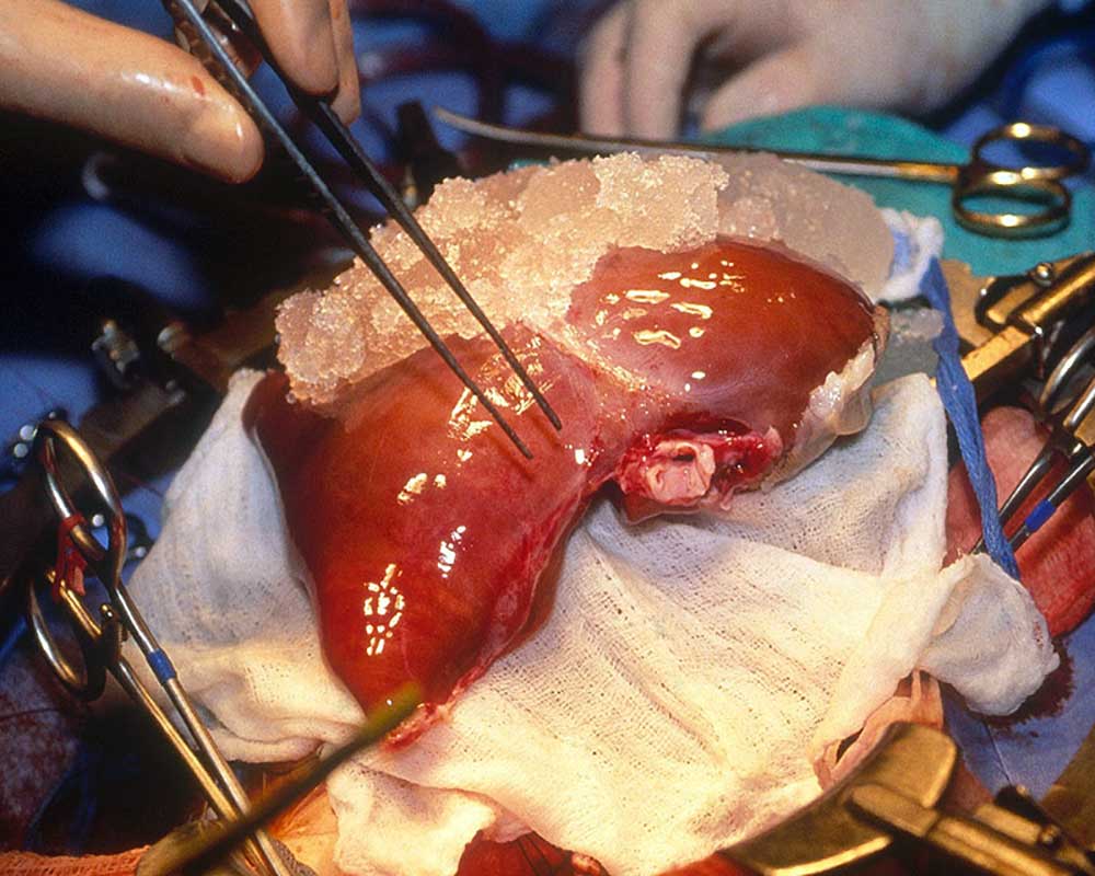 operating human liver