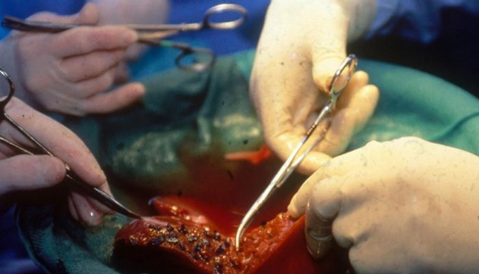 Liver Transplant Surgey What To Expect Fatty Liver Disease