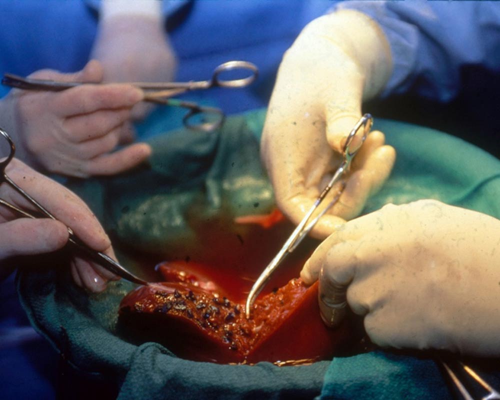 Liver transplant surgery