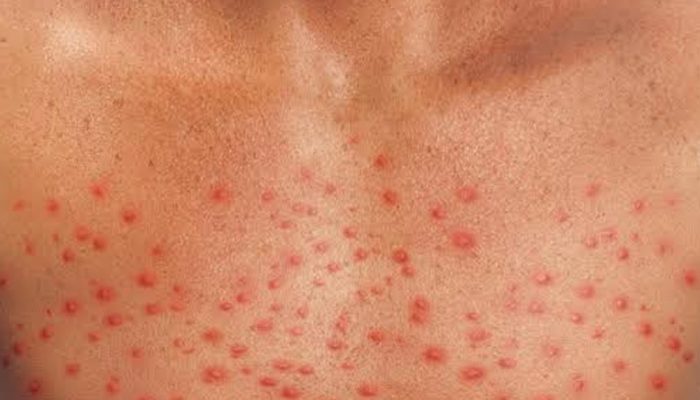 What Does Cirrhosis Skin Rash Look Like