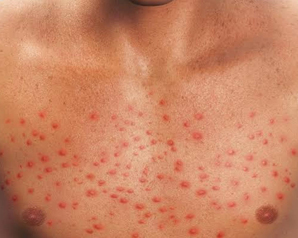 Liver Disease Itchy Skin Rash 