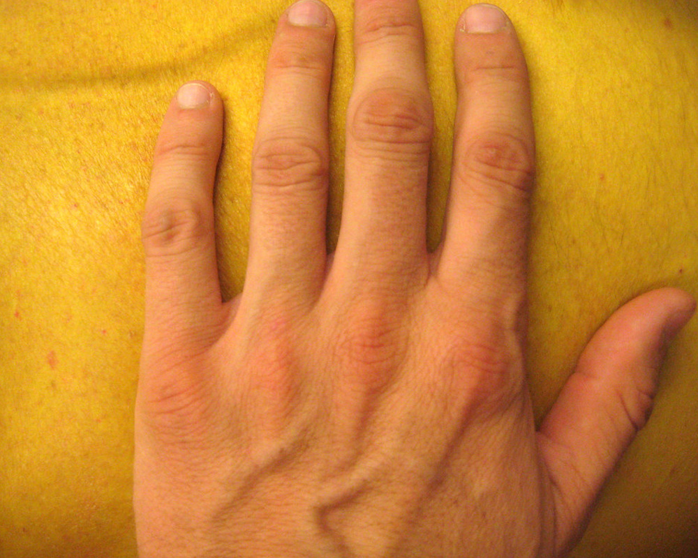 Jaundice Hands Causes And Treatment Fatty Liver Disease