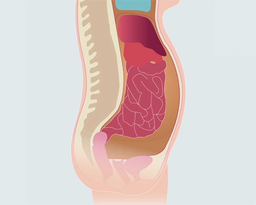 What Causes Ascites In Pelvis Fatty Liver Disease