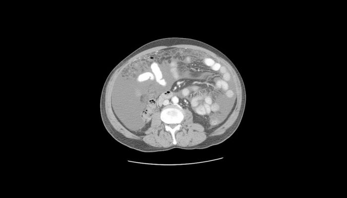 what-is-perihepatic-ascites-fatty-liver-disease