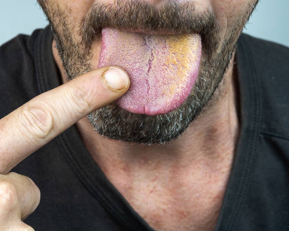 Causes, Symptoms and Treatment of Yellow Tongue | Fatty Liver Disease