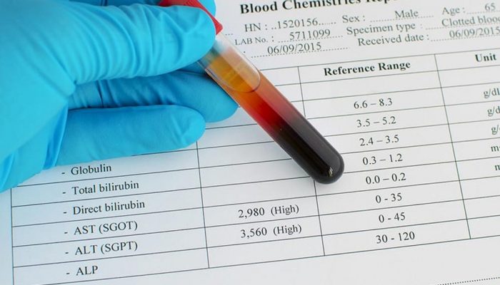 Low AST Levels Of Blood: What Causes It? - Fatty Liver Disease