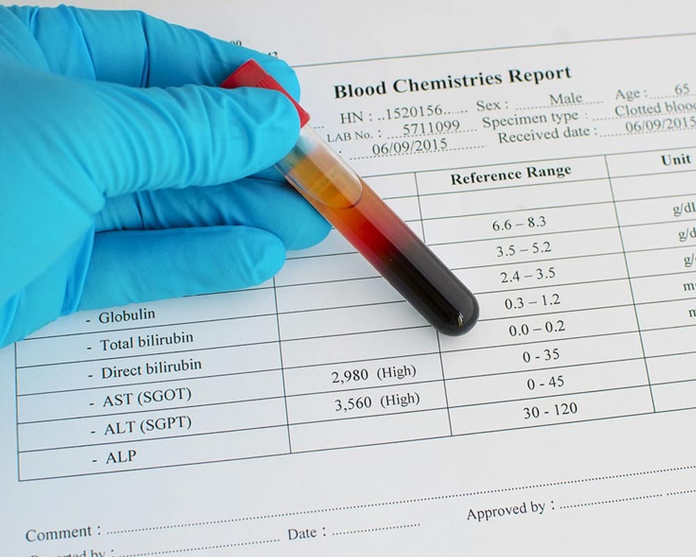 AST level Test Result and a blood sample