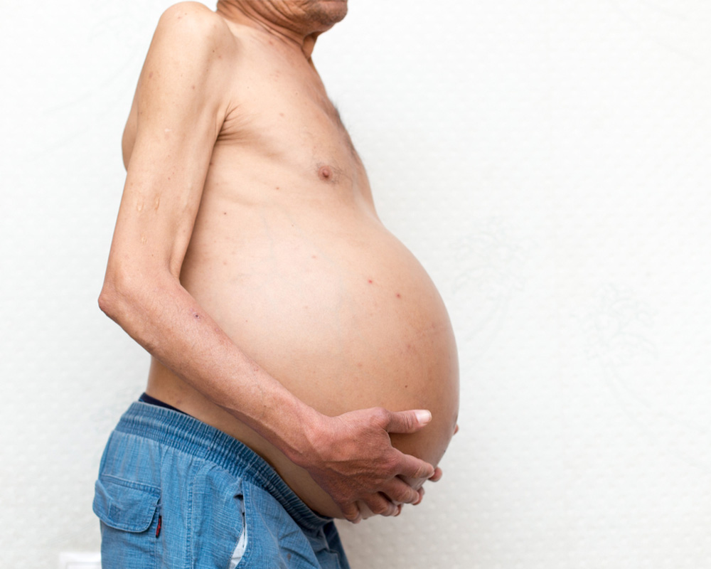 Man with abdominal ascites