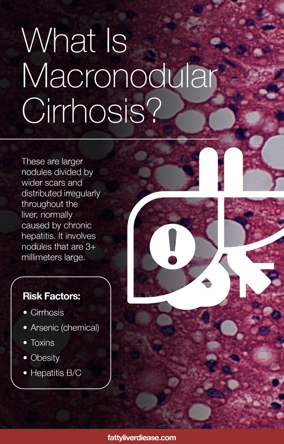 what-is-macronodular-cirrhosis-fatty-liver-disease