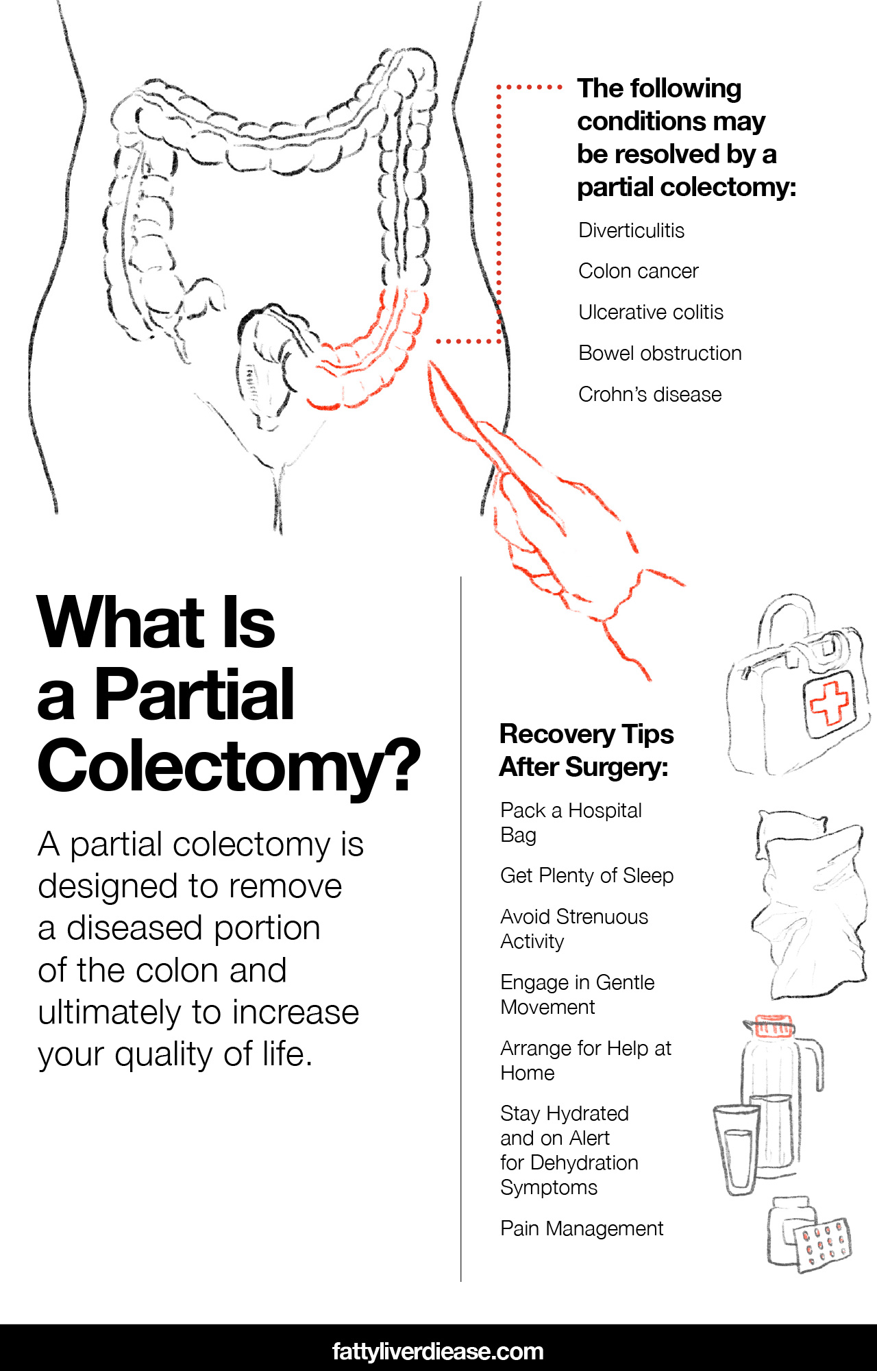 What Is a Partial Colectomy?