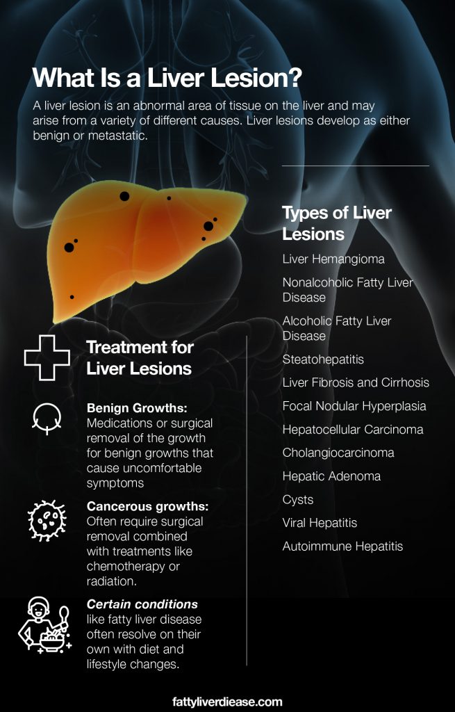 What Does It Mean to Have Liver Lesions? - Fatty Liver Disease