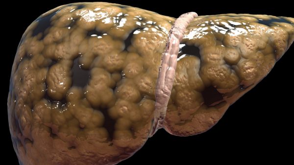 What Is Hepatic Steatosis? | Fatty Liver Disease